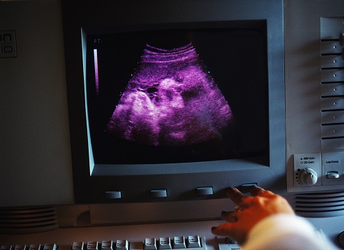 ultrasound monitor